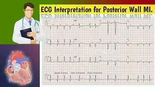 How to look for Posterior Wall MI on an ECG || Posterior Wall MI 
