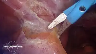 Total Laparoscopic Hysterectomy for DIE and Cystic Adenomyosis of the RVS | Safe Laparoscopy