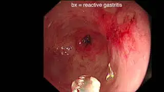GASTRIC ULCER HEALING