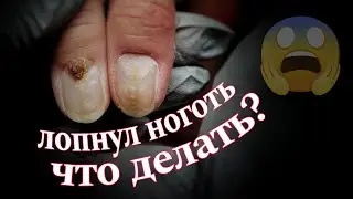😨ЛОПНУЛ НОГОТЬ! ❓Что делать? 👌🏻Зачистка и протезирование😉часть 1