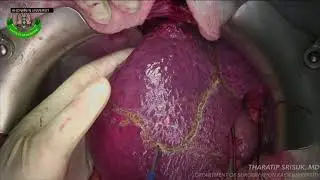 Anatomical segmentectomy S8 of hepatocellular carcinoma
