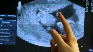 First Ultrasound of Our Second Baby