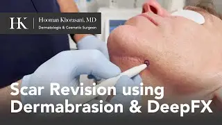 How To Remove a Scar on your Chin | Dr. Hooman Khorasani