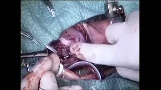 Hemitruncus Repair