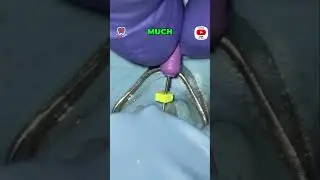 Achieving Precise Working Length in Endodontics