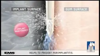 Dental treatment with the AIRFLOW® PERIOFLOW Method (English)