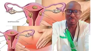 ce que les femmes doivent faire pour traiter les fibromes