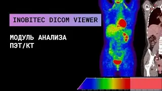 Анализ ПЭТ/КТ в Инобитек DICOM-Просмотрщике, редакция Pro