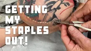 Getting the staples removed from my above knee residual limb
