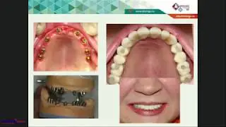 2018 02 27  ХАБИЕВ К    Ортопедические и хирургические аспекты тотального протезирования с немедленн
