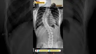 कमर के टेडेपन का ऐसे होता है इलाज | Dr Sunil Tank #spine #pain #scoliosis #sciatica #discbulge