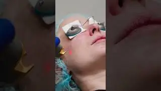 Laser Genesis Skin Rejuvenation