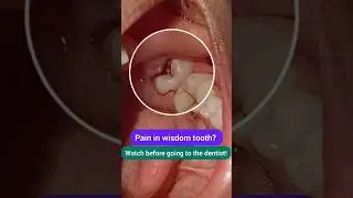 Pain in Wisdom Tooth? Watch before you go to the Dentist! Dr. Srishti Bhatia 