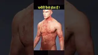 घमौरी (Heat Rash) #science