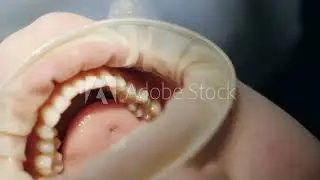 Girl at the dentist receiving invisible braces