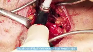 ESVS 2021: Prof. Vikatmaa and carotid endarterectomy surgery