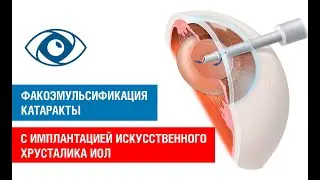 Факоэмульсификация катаракты с имплантацией искусственного хрусталика ИОЛ