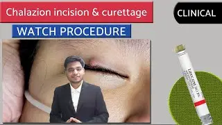 CHALAZION | Chalazion Excision || INCISION & CURETTAGE ||  surgery video || opthalmology