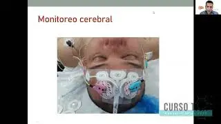 TIVA TCI Caso Clínico en Tiempo Real