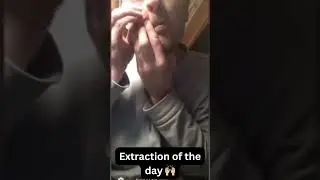 Extraction of the day 🙌🏼