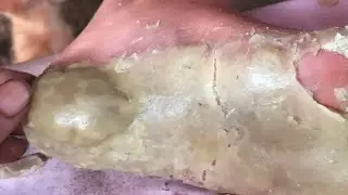 How to removal skin | callus removal skin flakes #34