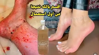 تهلاي في رجيلاتك  توريد وترطيب وتبييض وحتى لطراس سندالة غادي يحيد❤