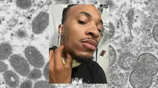 'It still hurts': Man shares painful fight with monkeypox