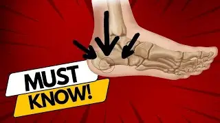 Surprising Truth about Heel Spurs (plus treatments to try at home)