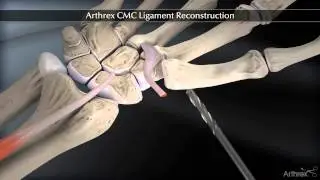 Arthrex CMC Ligament Reconstruction
