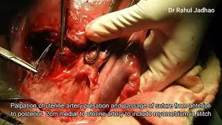 Management of uterine artery laceration at caesarean section