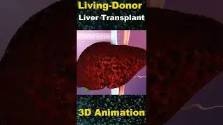 The Gift of Life: Understanding Living Donor Liver Transplantation