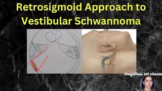 245.Retrosigmoid approach to vestibular schwannoma #surgeryeducation