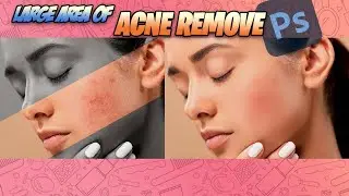 Photoshop CC : Large Area of Acne or Spots Remove