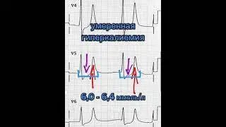 #гиперкалиемия  #ecg #экг #shorts