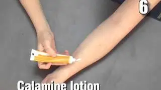 How to Treat a Mosquito Bite