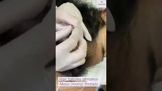 Training: Hair stimulation meso threads - technique