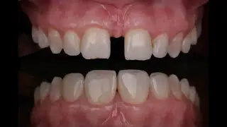 Закрытие диастемы. Стоматология. Зубы. Стоматолог. Диастема