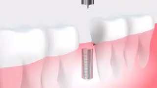Tooth Implant Animated Surgical video for medical interns