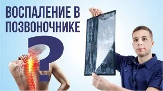 Воспаление в позвоночнике? Сакроилеит и болезнь Бехтерева в практике невролога. Что делать.