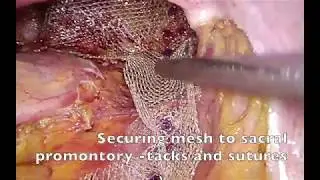 Laparoscopic ventral mesh rectopexy for rectal prolapse and obstructed defaecation