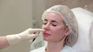 Контурная пластика лица с помощью филлеров 