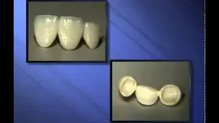 Porcelain Bridges - Miskin Ajax Dental