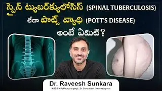 Spinal TB (Pott's Disease) Symptoms, Treatment, and Prevention | | Dr. Raveesh| Best Neurosurgeon