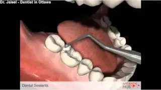 Preventive - Dental Sealants With Drill - Dentists In Ottawa