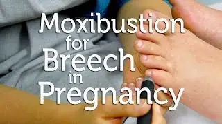 Moxibustion for Breech in Pregnancy
