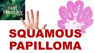 SQUAMOUS PAPILLOMA: Etiopathogenesis, Clinical Features and Pathology