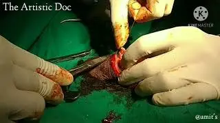 Case of Phimosis | Surgical Techniques of Circumcision