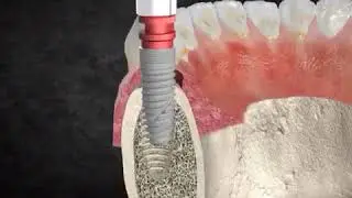 Установка импланта Semados