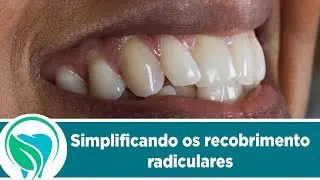Simplificando os recobrimentos radiculares