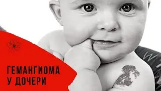 Гемангиома у дочери